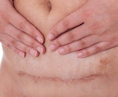 Cảm giác nào sau phẫu thuật có thể là dấu hiệu của thoát vị vết mổ